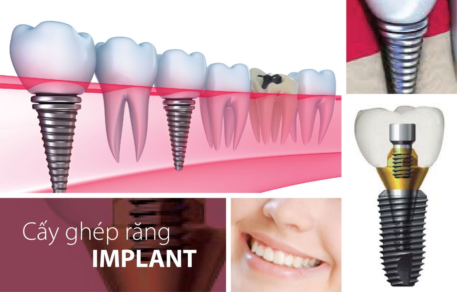 Bảng giá trồng implant