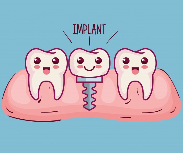 Bảng giá trồng implant