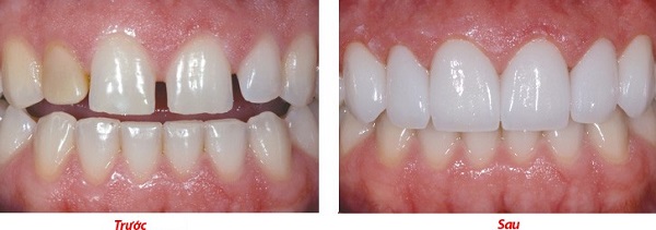 Điều trị khe thưa giữa hai răng cửa tại nha khoa uy tín chất lượng
