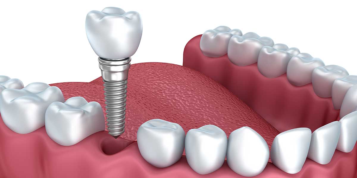 Tìm hiểu về quy trình cấy ghép răng implant