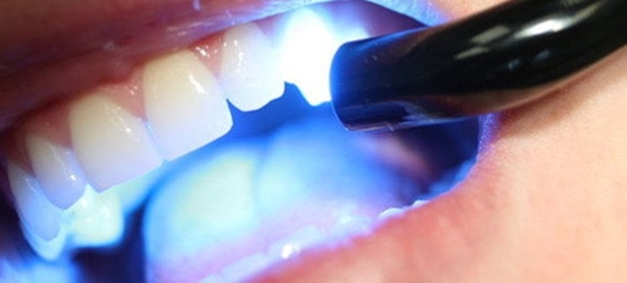 Trám răng thẩm mỹ tại nha khoa Solar khắc phục tình trạng răng thưa hàm trên