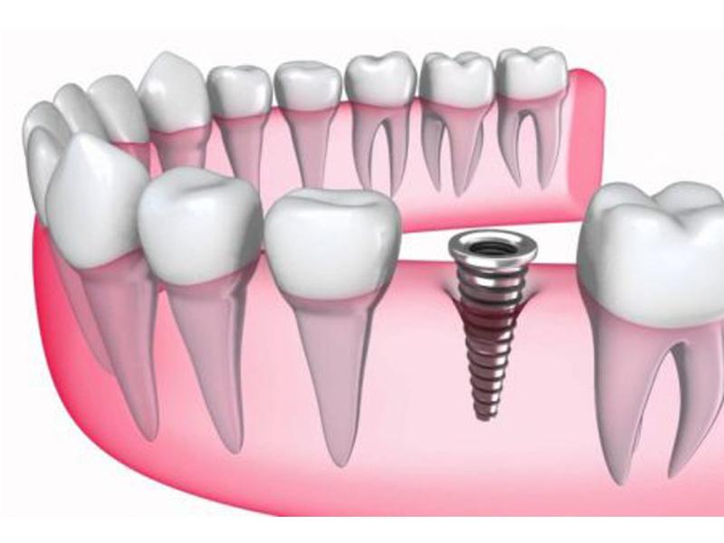 dịch vụ implant