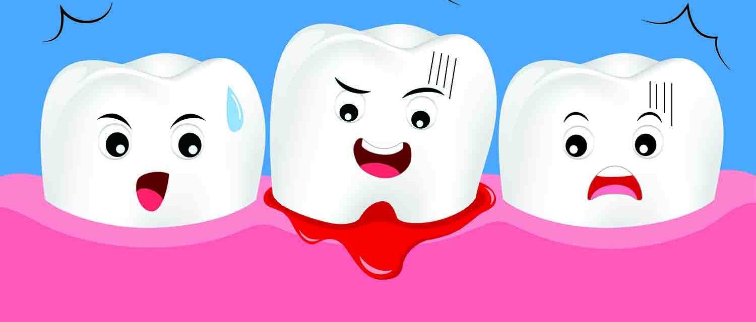 Bệnh về răng Bệnh về răng