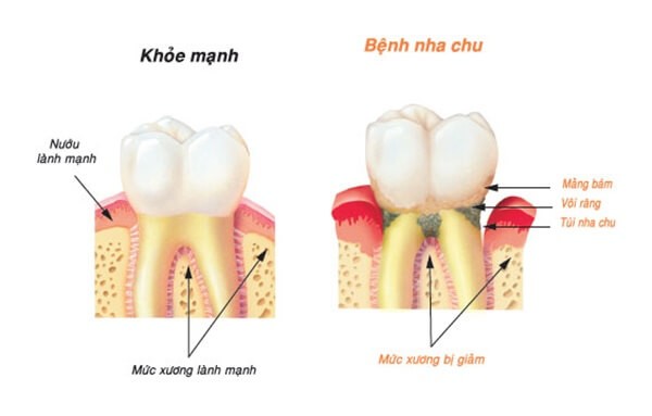 Bệnh về răng Bệnh về răng