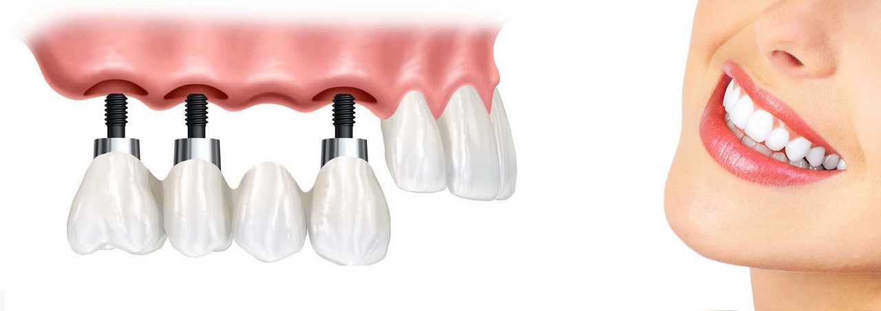 Trồng răng implant Trồng răng implant