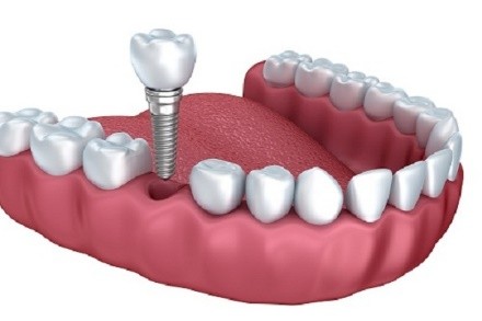 Trồng răng implant Trồng răng implant