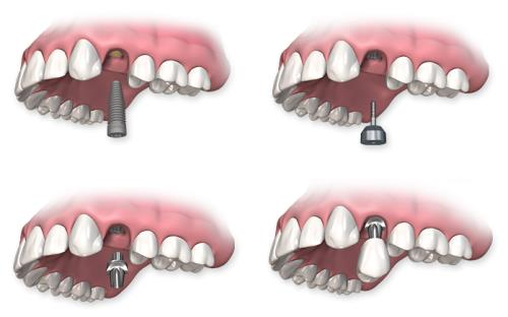 Trồng răng implant Trồng răng implant