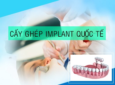 Trồng răng implant Trồng răng implant