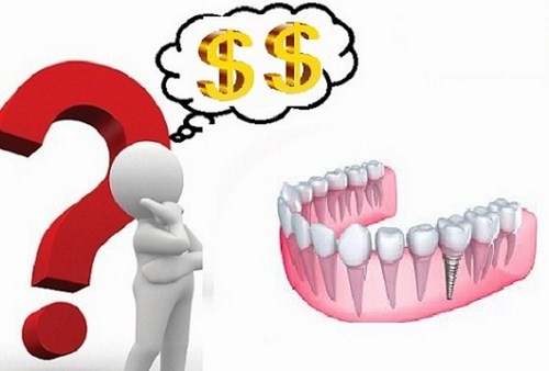 Trồng răng implant Trồng răng implant