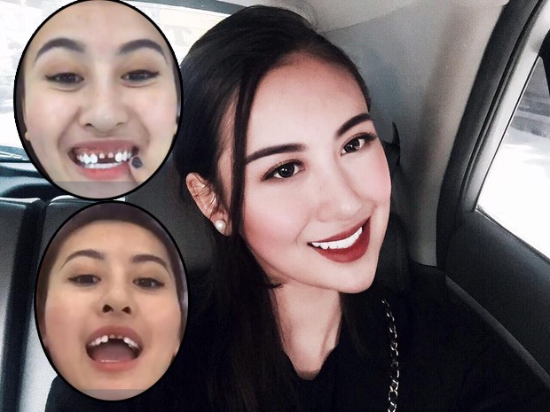 tưng bừng khuyến mãi cùng nha khoa 3t tưng bừng khuyến mãi cùng nha khoa