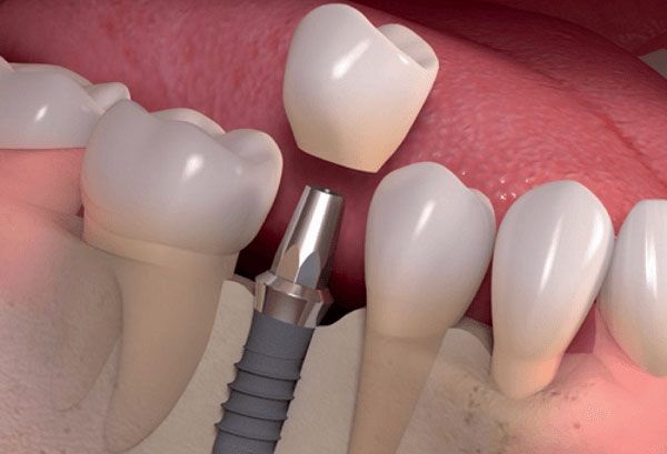Bệnh viêm quanh implant ở bệnh nhân trồng răng implant Bệnh viêm quanh implant ở bệnh nhân trồng răng implant