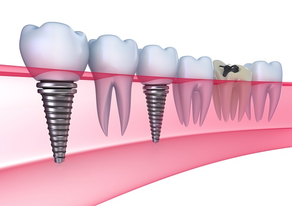 Bệnh viêm quanh implant ở bệnh nhân trồng răng implant Bệnh viêm quanh implant ở bệnh nhân trồng răng implant