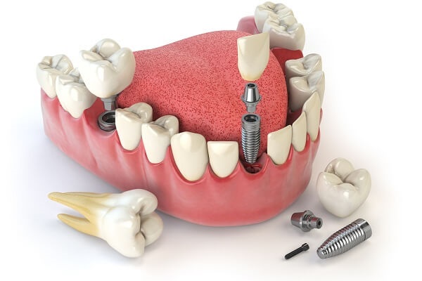 Bệnh viêm quanh implant ở bệnh nhân trồng răng implant Bệnh viêm quanh implant ở bệnh nhân trồng răng implant