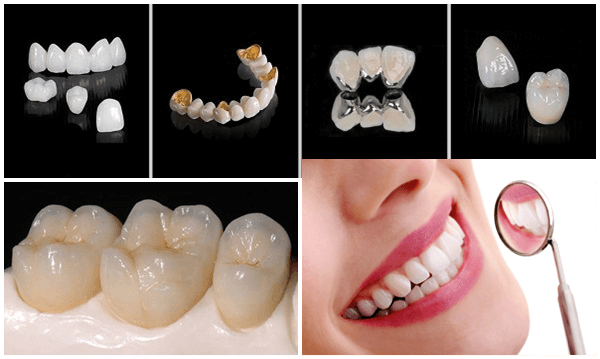 bọc răng sứ thẩm mỹ