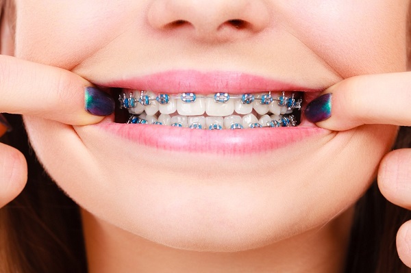 Chăm sóc niềng răng đúng cách Chăm sóc niềng răng đúng cách