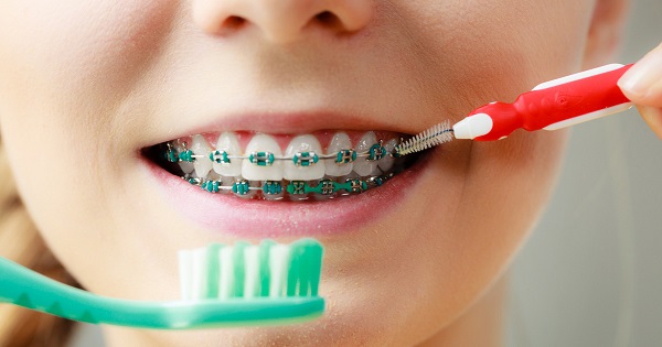 Chăm sóc niềng răng đúng cách Chăm sóc niềng răng đúng cách