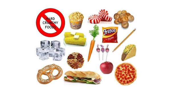 Chăm sóc niềng răng đúng cách Chăm sóc niềng răng đúng cách