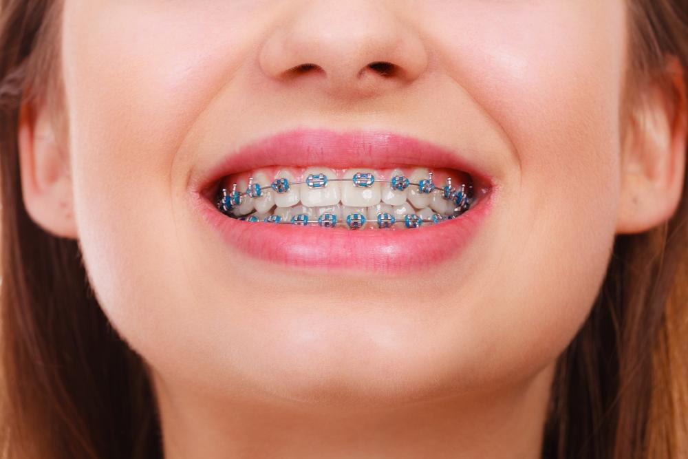 Chăm sóc răng miệng đúng cách trong suốt quá trình niềng răng