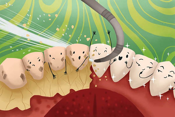 Có cần phải kiêng cữ sau khi cạo vôi răng Có cần phải kiêng cữ sau khi cạo vôi răng