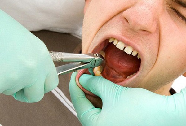 Có nên nhổ răng khôn mọc lệch mọc ngầm hay không Có nên nhổ răng khôn mọc lệch mọc ngầm hay không