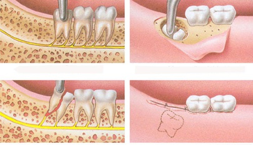 Dấu hiệu cần nhổ răng khôn Dấu hiệu cần nhổ răng khôn