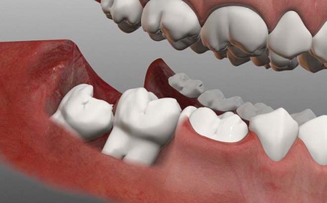 Dấu hiệu cần nhổ răng khôn Dấu hiệu cần nhổ răng khôn