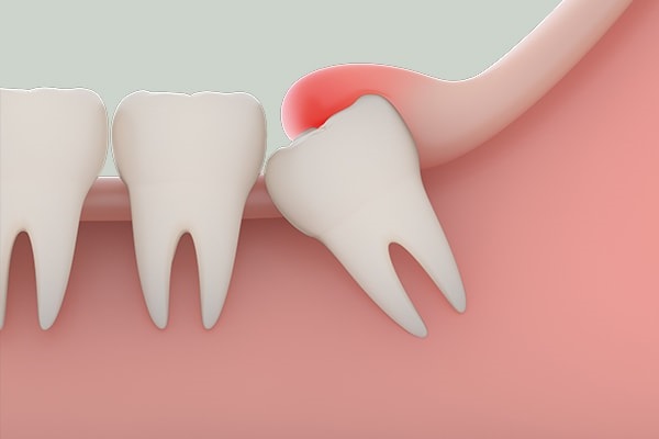 Dấu hiệu cần nhổ răng khôn Dấu hiệu cần nhổ răng khôn