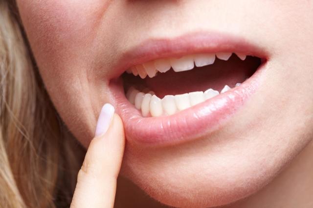 Dấu hiệu cần nhổ răng khôn Dấu hiệu cần nhổ răng khôn