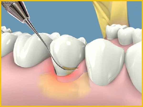 Dấu hiệu của bệnh viêm nha chu
