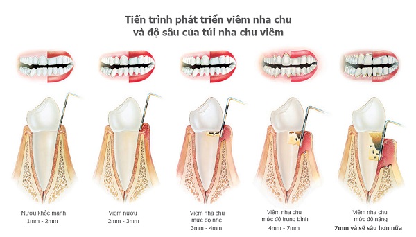 Dấu hiệu của bệnh viêm nha chu Dấu hiệu của bệnh viêm nha chu