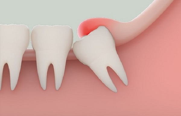 Nên hay không nên loại bỏ răng khôn Nên hay không nên loại bỏ răng khôn