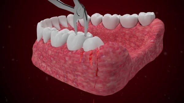 Nên hay không nên loại bỏ răng khôn Nên hay không nên loại bỏ răng khôn