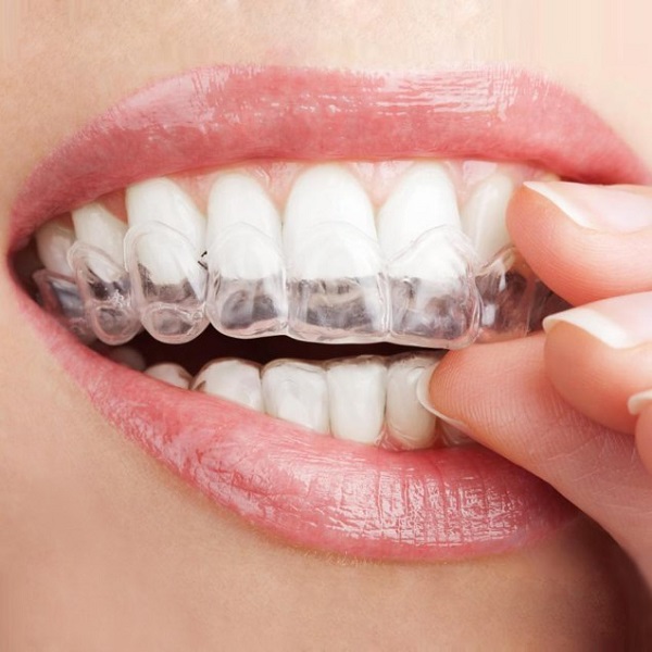 Những thông tin cần biết về máng tẩy trắng răng Những thông tin cần biết về máng tẩy trắng răng