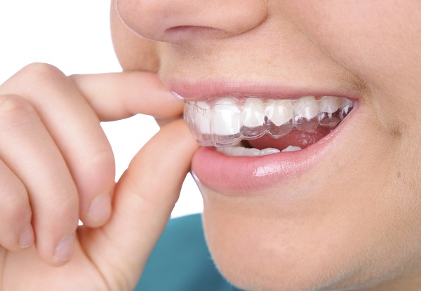 Những thông tin cần biết về máng tẩy trắng răng
