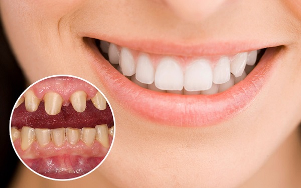 Những trường hợp không nên bọc răng sứ Những trường hợp không nên bọc răng sứ