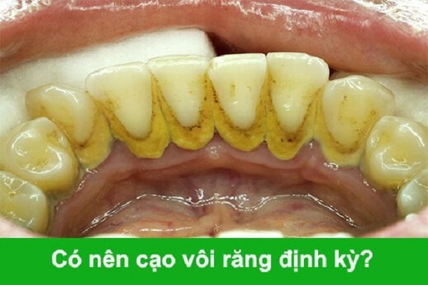 Tác hại của vôi răng Cạo vôi răng có đau hay không Tác hại của vôi răng Cạo vôi răng có đau hay không