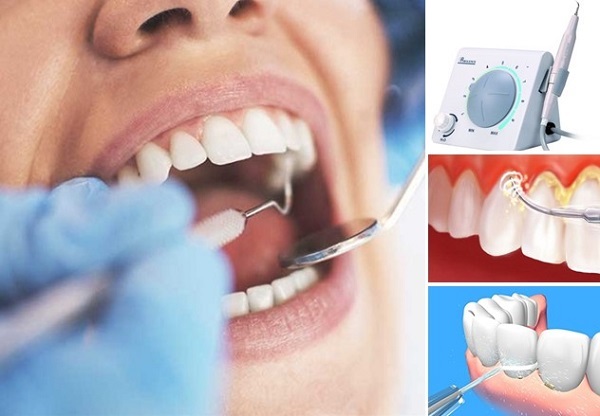 Tác hại của vôi răng Cạo vôi răng có đau hay không