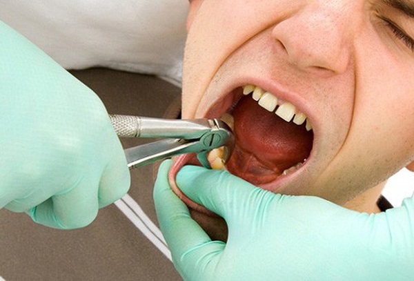 Thời gian để hồi phục sau khi nhổ răng khôn