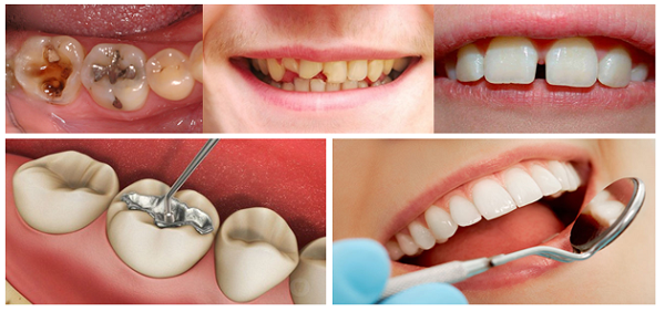 Thời gian sử dụng miếng trám răng là bao lâu Thời gian sử dụng miếng trám răng là bao lâu
