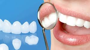 Bọc răng sứ hiệu quả cho những trường hợp răng nào