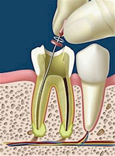 Cách điều trị tủy răng – nội nha