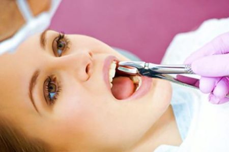 Có nên nhổ răng khôn số 8 không