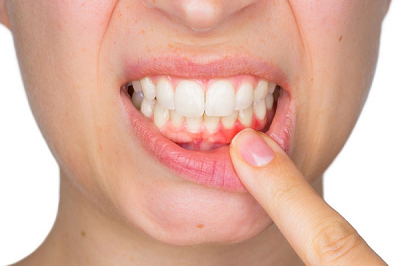 Điều trị viêm nha chu tại quận 10