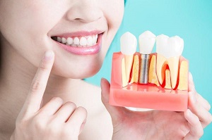 Làm thế nào để loại bỏ tartar trên răng