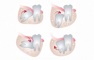 Nên hay không nên loại bỏ răng khôn