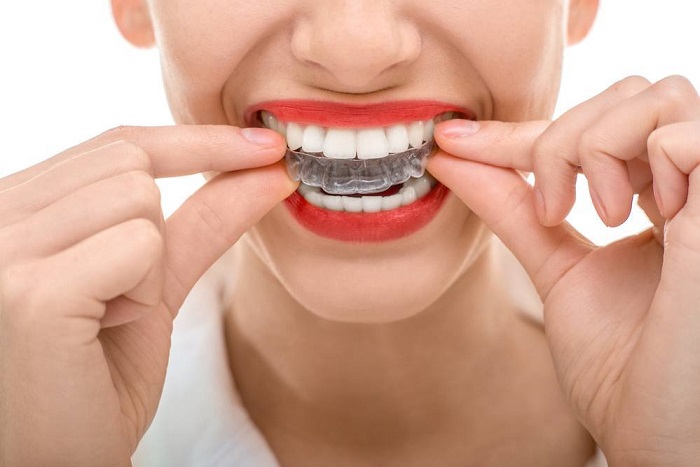 Nên niềng răng bằng phương pháp nào