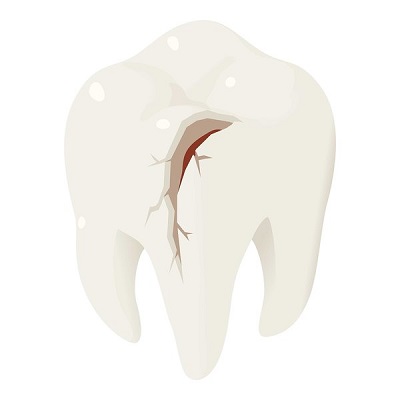 Những cách chữa trị cho răng bị vỡ mẻ