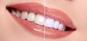 Những thông tin cần biết về máng tẩy trắng răng