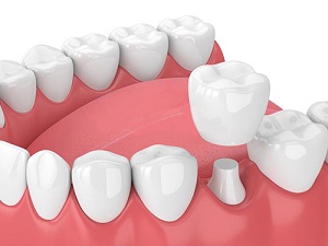 Những trường hợp không nên bọc răng sứ