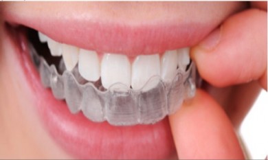 Niềng răng trong suốt có tốt hơn niềng răng kim loại